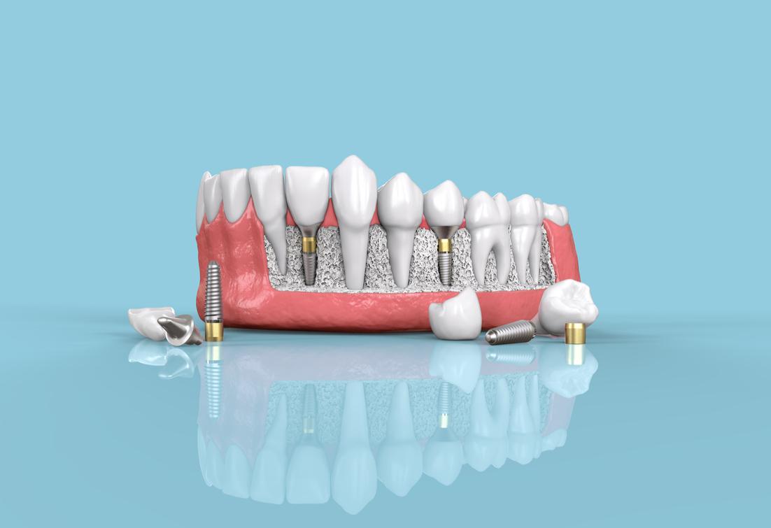 Dental Implants Aspen Hill, MD